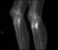 Posteromedial Tibial Stress Fracture